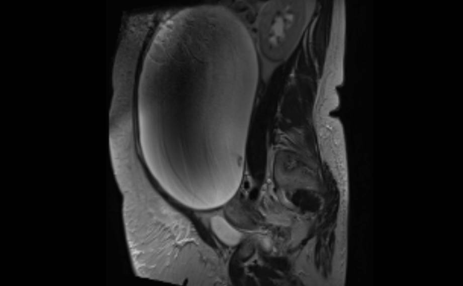 Medical illustration explaining ovarian cysts in the ovary
