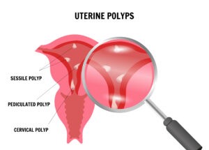 Illustration showing uterine polyps and their effect on the uterine lining